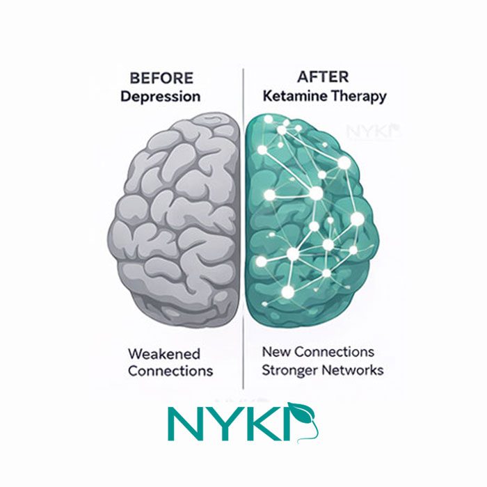 Iv Ketamine Infusions In Melville Ny
